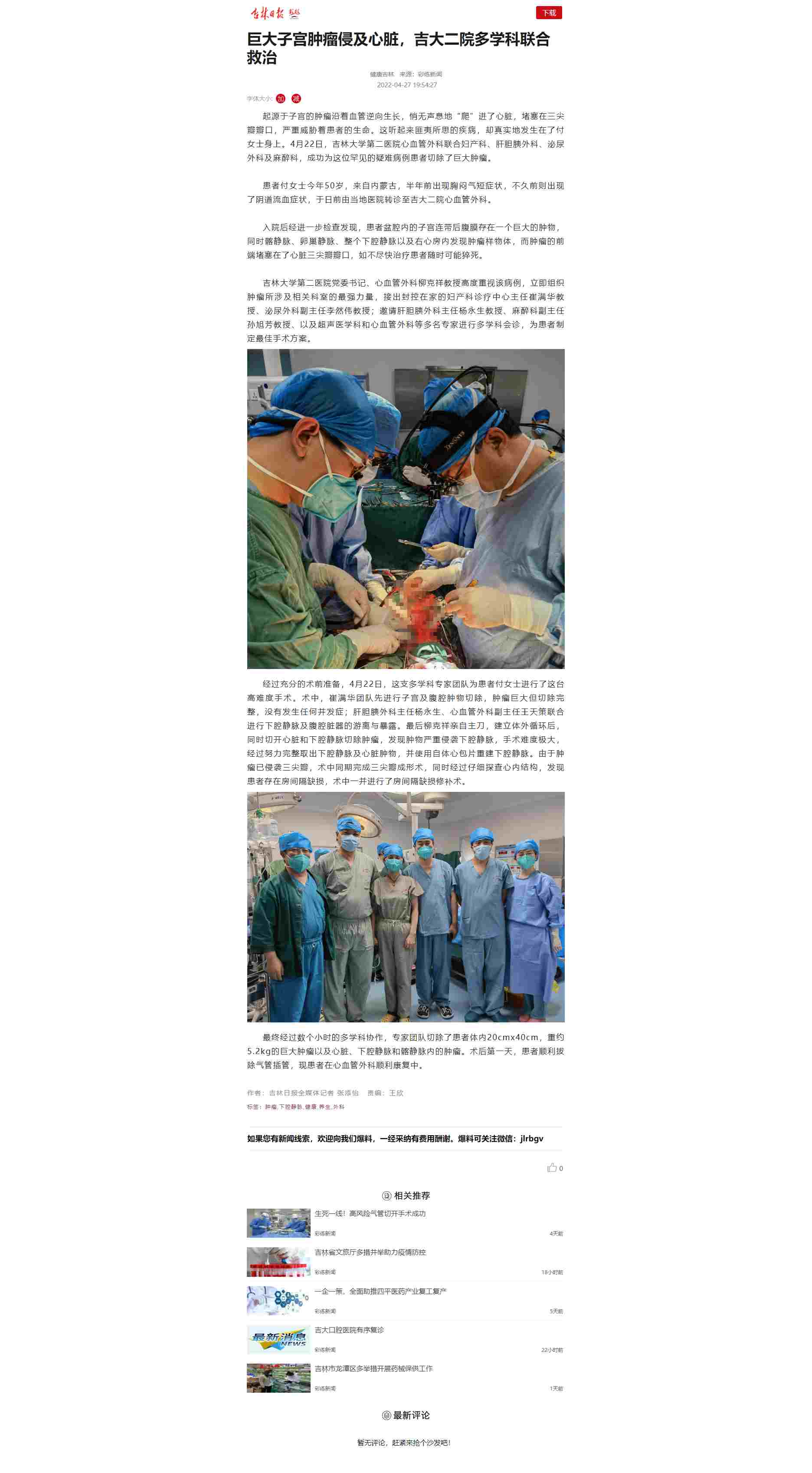 【吉林日报】巨大子宫肿瘤侵及心脏，吉大二院多学科联合救治.jpg