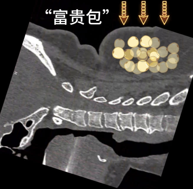 2手术示意图.jpg 2手术示意图.jpg