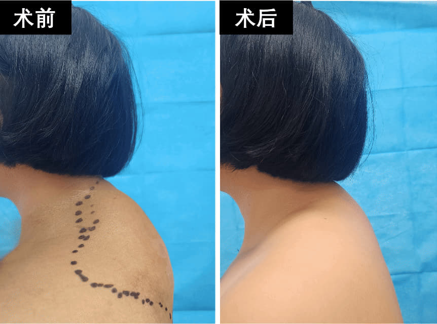 3术前和术后身形对比.jpg 3术前和术后身形对比.jpg