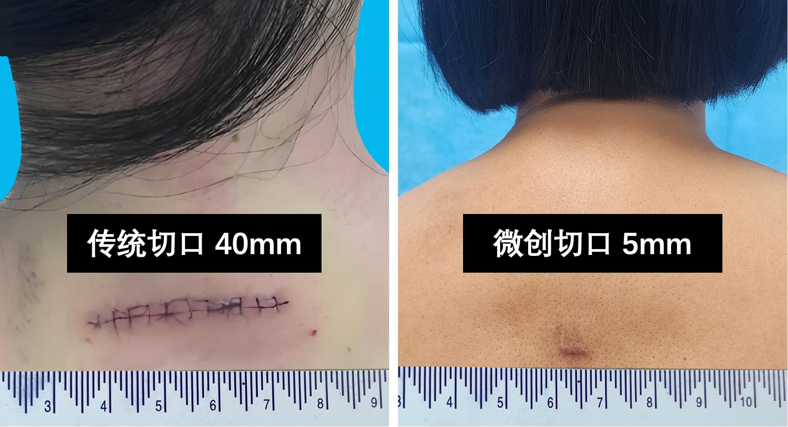 4传统和微创手术切口对比.jpg 4传统和微创手术切口对比.jpg